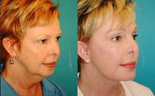 Facelift Before & After Gallery - Patient 122405802 - Image 2