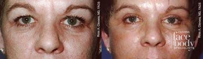 Eyelid Surgery Before & After Gallery - Patient 128690 - Image 1
