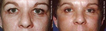 Eyelid Surgery Before & After Gallery - Patient 122405800 - Image 1
