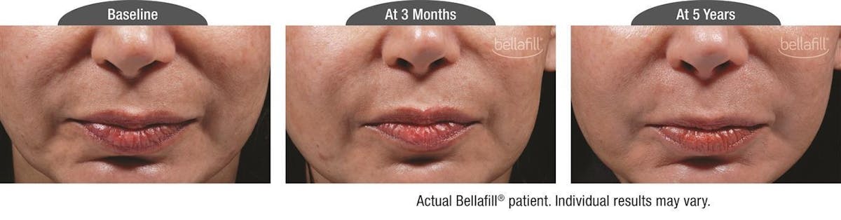 Dermal Fillers Before & After Gallery - Patient 122405801 - Image 1