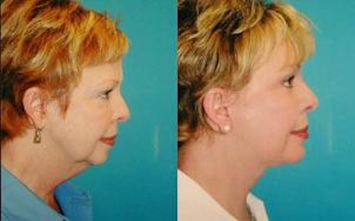 Facelift Before & After Gallery - Patient 122405802 - Image 3