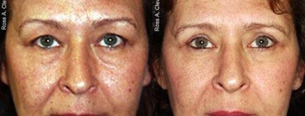 Eyelid Surgery Before & After Gallery - Patient 122405803 - Image 1