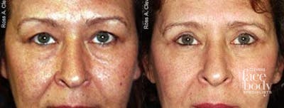 Eyelid Surgery Before & After Gallery - Patient 364054 - Image 1