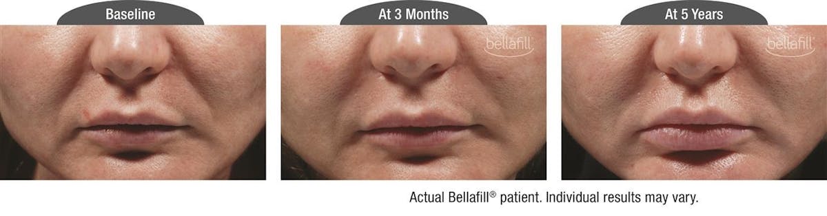 Dermal Fillers Before & After Gallery - Patient 122405804 - Image 1