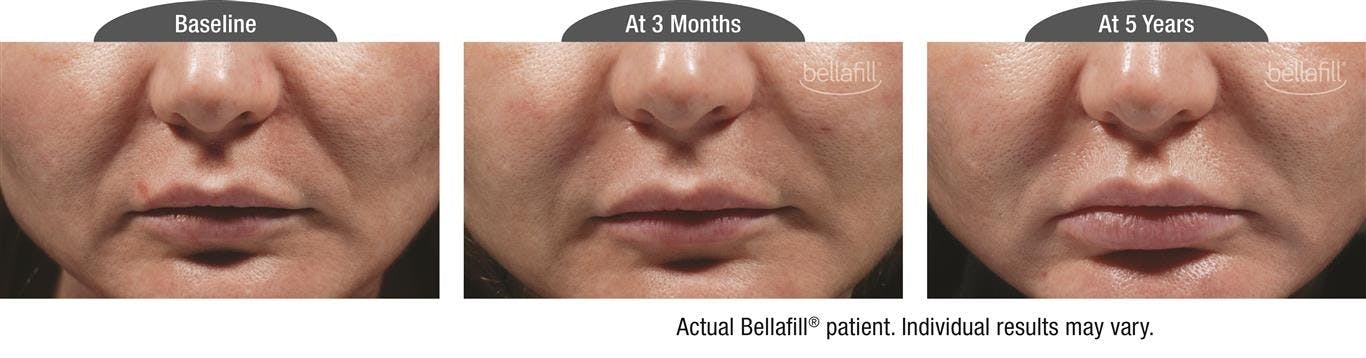Dermal Fillers Before & After Gallery - Patient 122405804 - Image 1