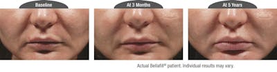 Dermal Fillers Before & After Gallery - Patient 122405804 - Image 1