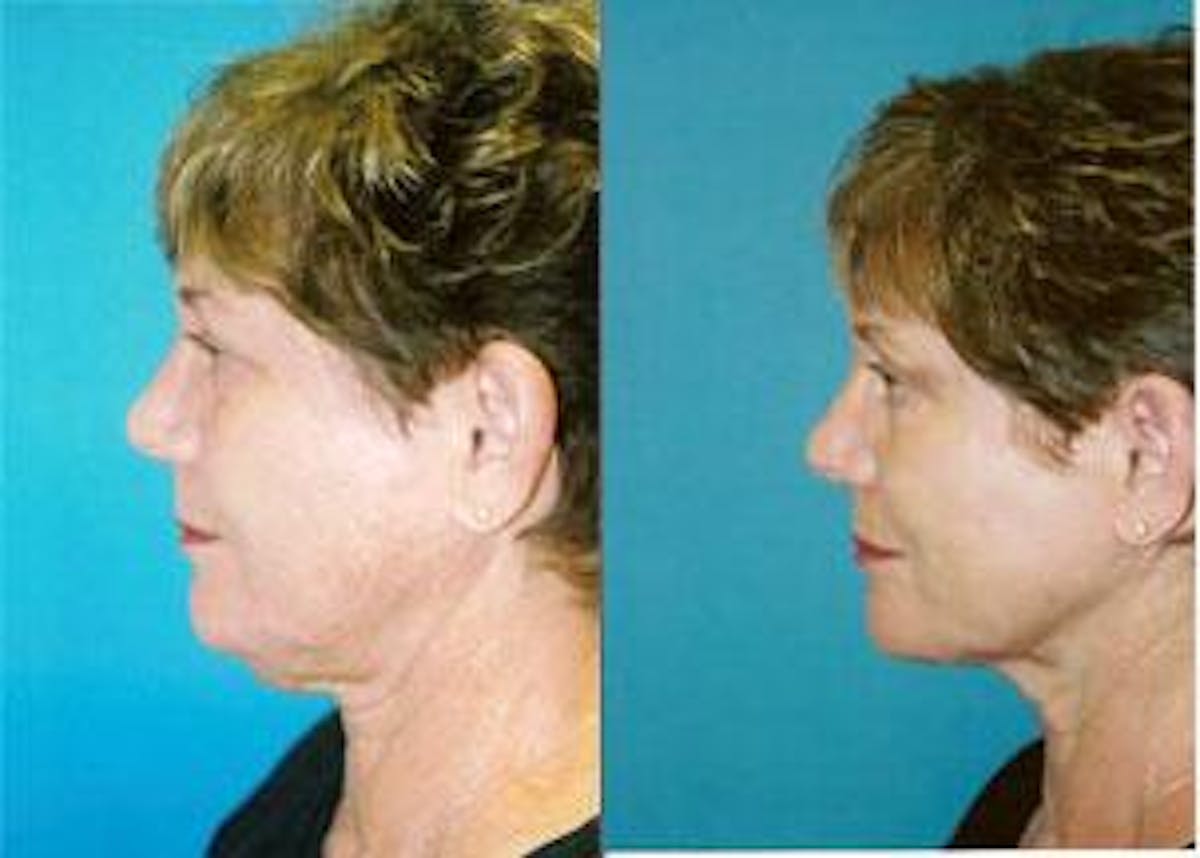 Facelift Before & After Gallery - Patient 122405806 - Image 1