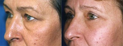 Eyelid Surgery Before & After Gallery - Patient 122405805 - Image 1