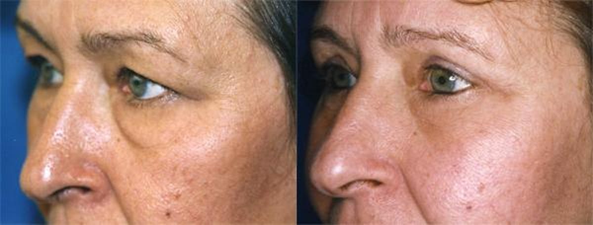 Eyelid Surgery Before & After Gallery - Patient 122405805 - Image 1