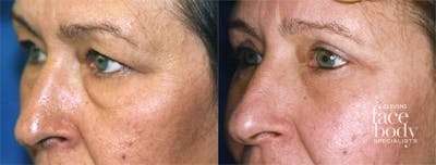 Eyelid Surgery Before & After Gallery - Patient 151880 - Image 1