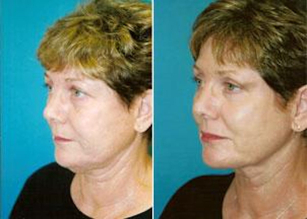 Facelift Before & After Gallery - Patient 122405806 - Image 2