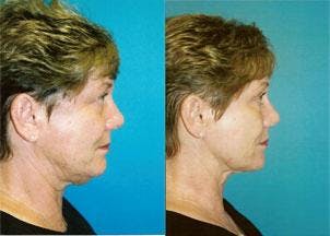 Facelift Before & After Gallery - Patient 122405806 - Image 3