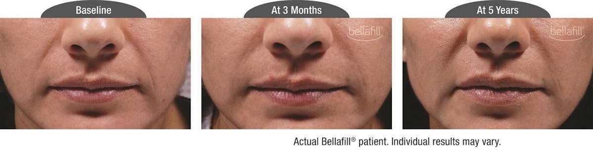 Dermal Fillers Before & After Gallery - Patient 122405807 - Image 1