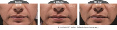 Dermal Fillers Before & After Gallery - Patient 122405807 - Image 1