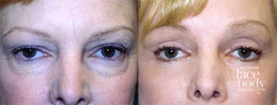 Eyelid Surgery Before & After Gallery - Patient 347620 - Image 1