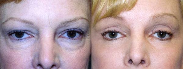 Eyelid Surgery Before & After Gallery - Patient 122405808 - Image 1