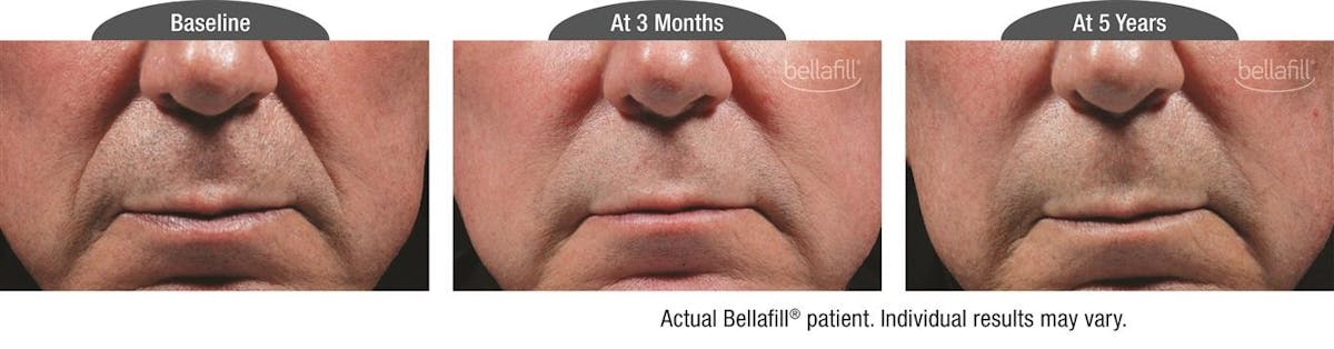 Dermal Fillers Before & After Gallery - Patient 122405809 - Image 1