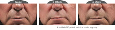 Dermal Fillers Before & After Gallery - Patient 122405809 - Image 1
