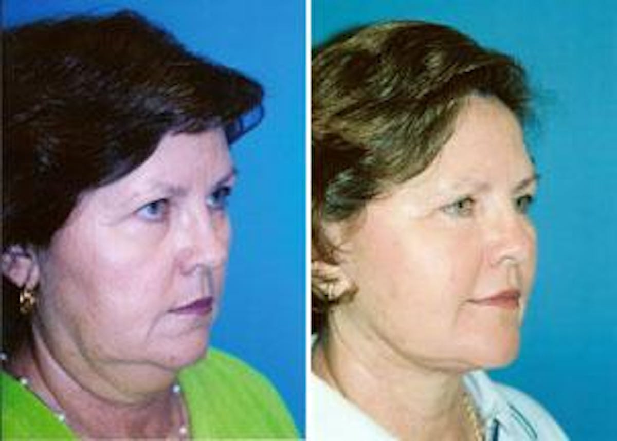 Facelift Before & After Gallery - Patient 122405811 - Image 1