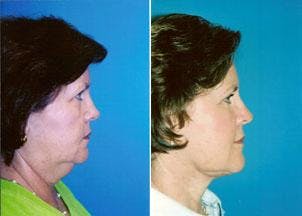 Facelift Before & After Gallery - Patient 122405811 - Image 2