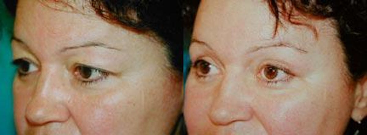 Eyelid Surgery Before & After Gallery - Patient 122405810 - Image 1