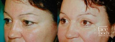 Eyelid Surgery Before & After Gallery - Patient 196007 - Image 1