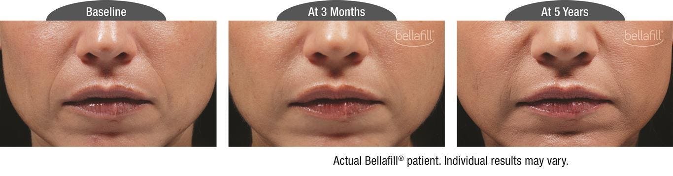 Dermal Fillers Before & After Gallery - Patient 122405812 - Image 1