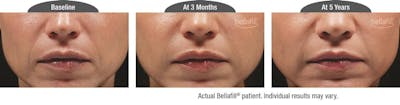 Dermal Fillers Before & After Gallery - Patient 122405812 - Image 1