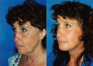 Facelift Before & After Gallery - Patient 122405813 - Image 1