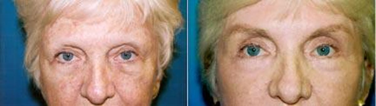 Eyelid Surgery Before & After Gallery - Patient 122405814 - Image 1
