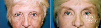Eyelid Surgery Before & After Gallery - Patient 200660 - Image 1