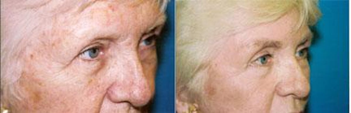 Eyelid Surgery Before & After Gallery - Patient 122405814 - Image 2