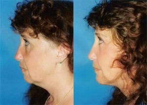 Facelift Before & After Gallery - Patient 122405813 - Image 2