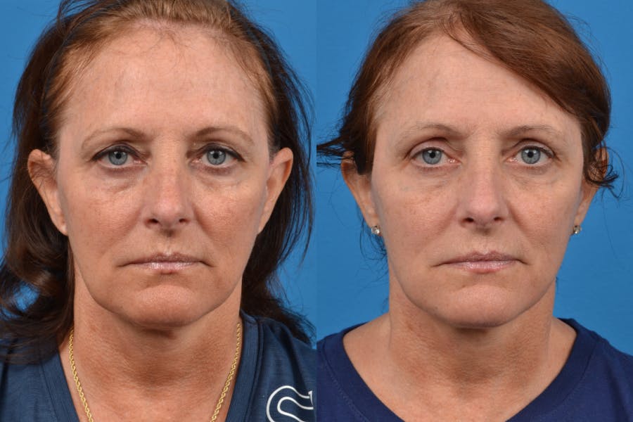 Dermal Fillers Before & After Gallery - Patient 122405817 - Image 1