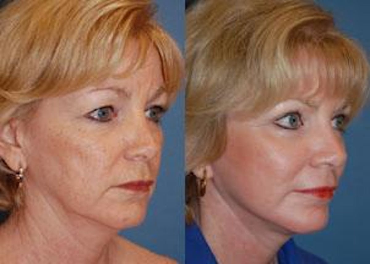 Facelift Before & After Gallery - Patient 122405815 - Image 1