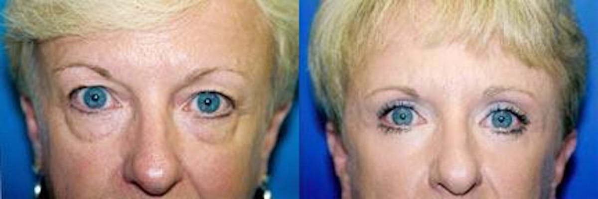 Eyelid Surgery Before & After Gallery - Patient 122405816 - Image 1