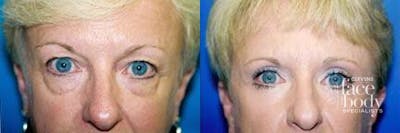 Eyelid Surgery Before & After Gallery - Patient 429274 - Image 1