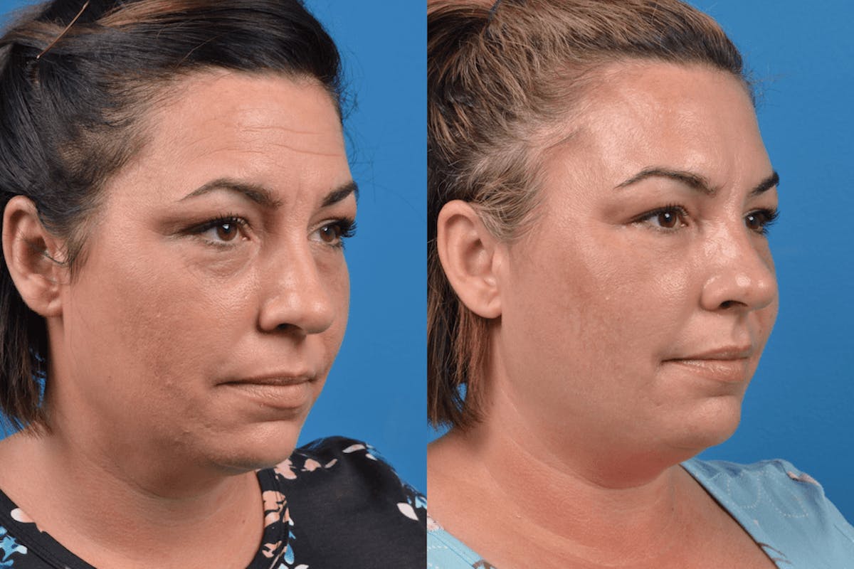 Dermal Fillers Before & After Gallery - Patient 122405817 - Image 2