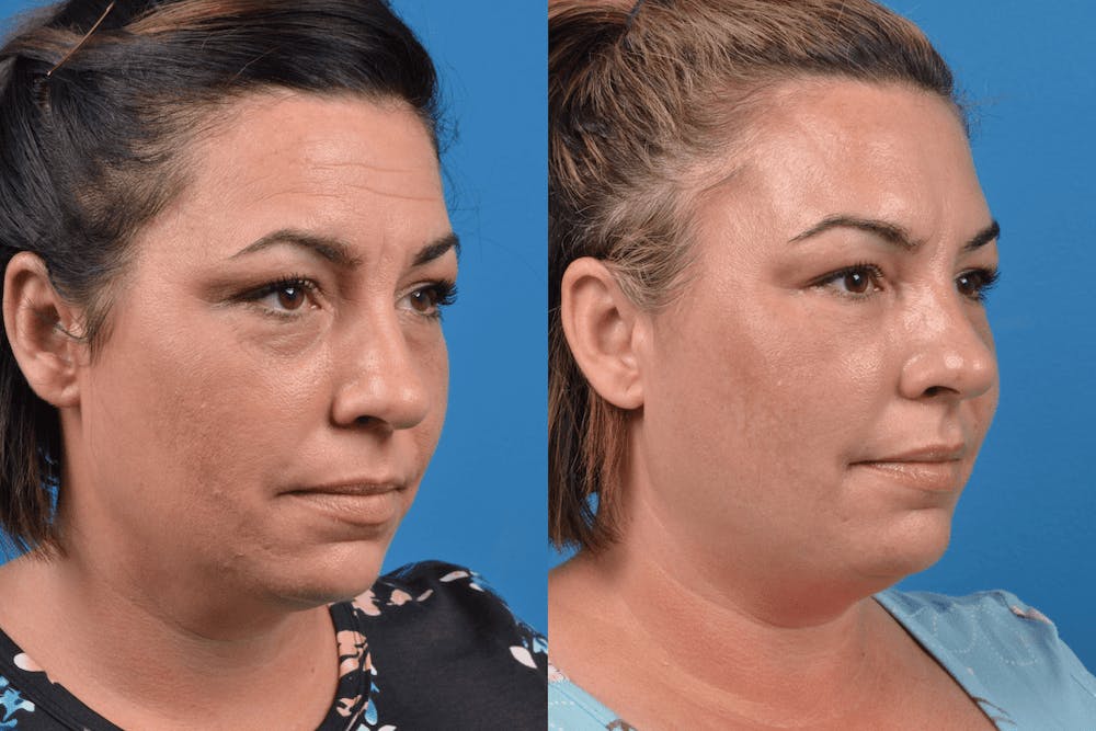 Dermal Fillers Before & After Gallery - Patient 122405817 - Image 2
