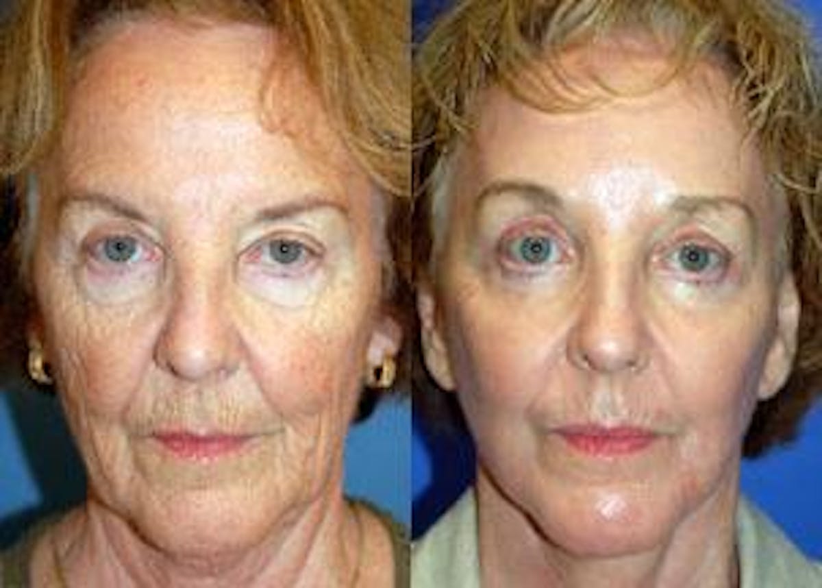 Facelift Before & After Gallery - Patient 122405819 - Image 1