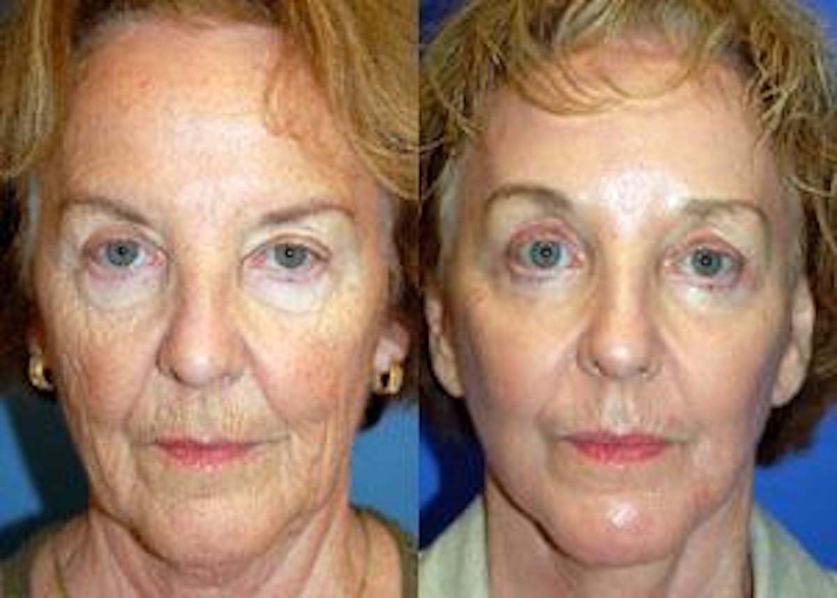 Facelift Before & After Gallery - Patient 122405819 - Image 1