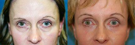 Eyelid Surgery Before & After Gallery - Patient 272380 - Image 1