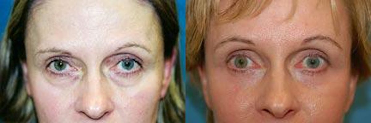 Eyelid Surgery Before & After Gallery - Patient 122405818 - Image 1