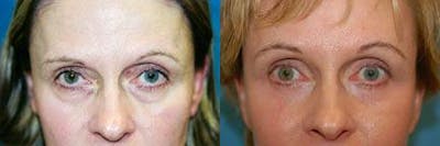 Eyelid Surgery Before & After Gallery - Patient 122405818 - Image 1