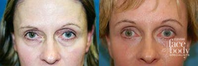 Eyelid Surgery Before & After Gallery - Patient 272380 - Image 1