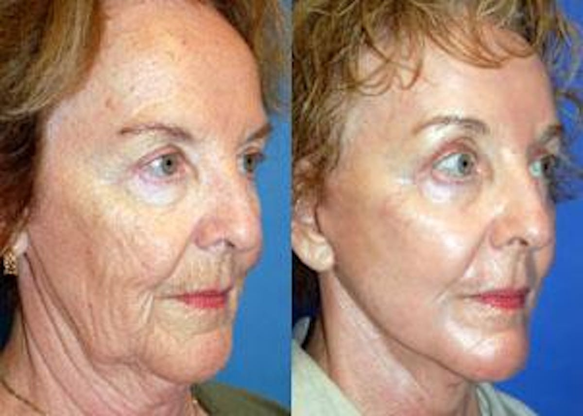 Facelift Before & After Gallery - Patient 122405819 - Image 2
