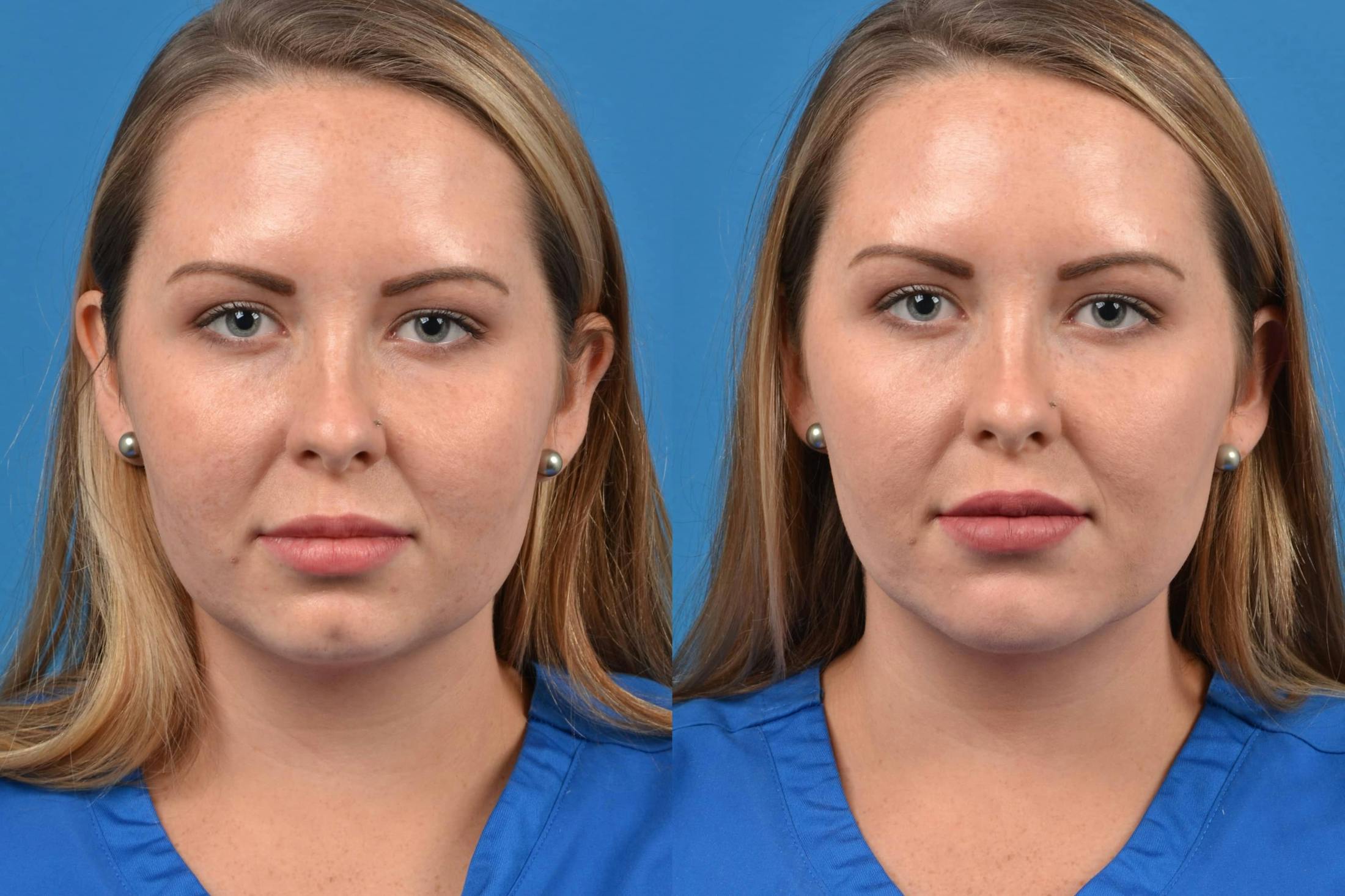 Dermal Fillers Before & After Gallery - Patient 122405825 - Image 1