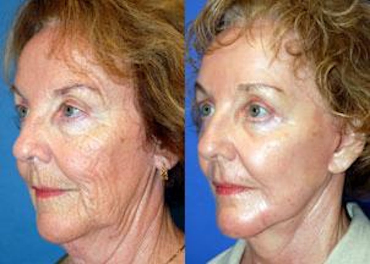Facelift Before & After Gallery - Patient 122405819 - Image 3