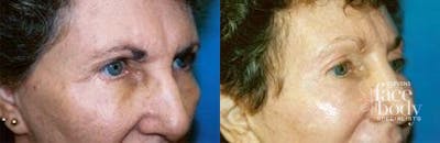 Eyelid Surgery Before & After Gallery - Patient 412955 - Image 1