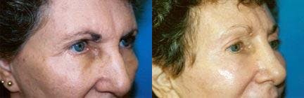 Eyelid Surgery Before & After Gallery - Patient 122405820 - Image 1